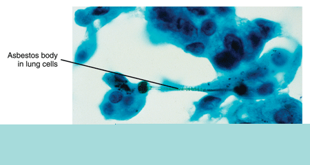 Asbestos particles in lung cells